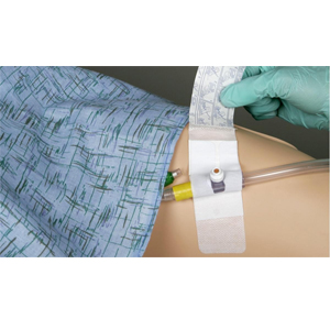 Adhesive Foley Securement Device