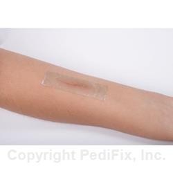 SoreSpot® Silicone Tape - Image 4